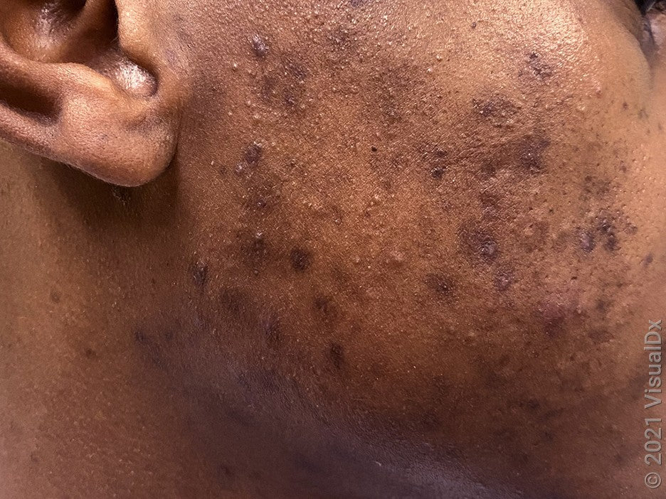 Acne Marks vs Acne Scars: What's Actually on Your Skin and How to Stop Making it Worse